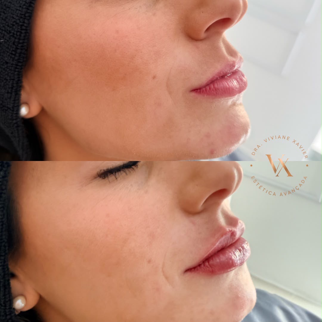 Antes e depois — lábios, resultado 1