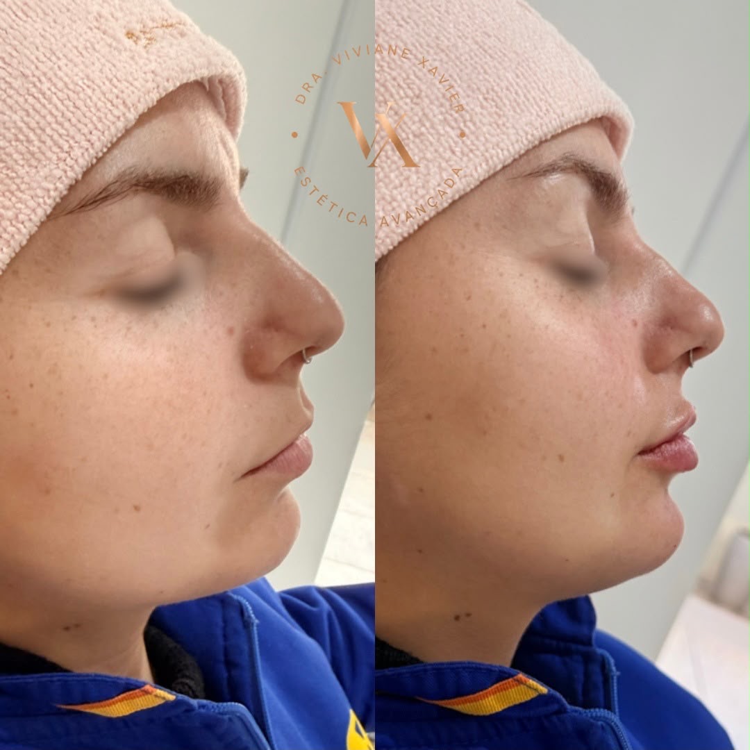 Antes e depois — lábios, resultado 2