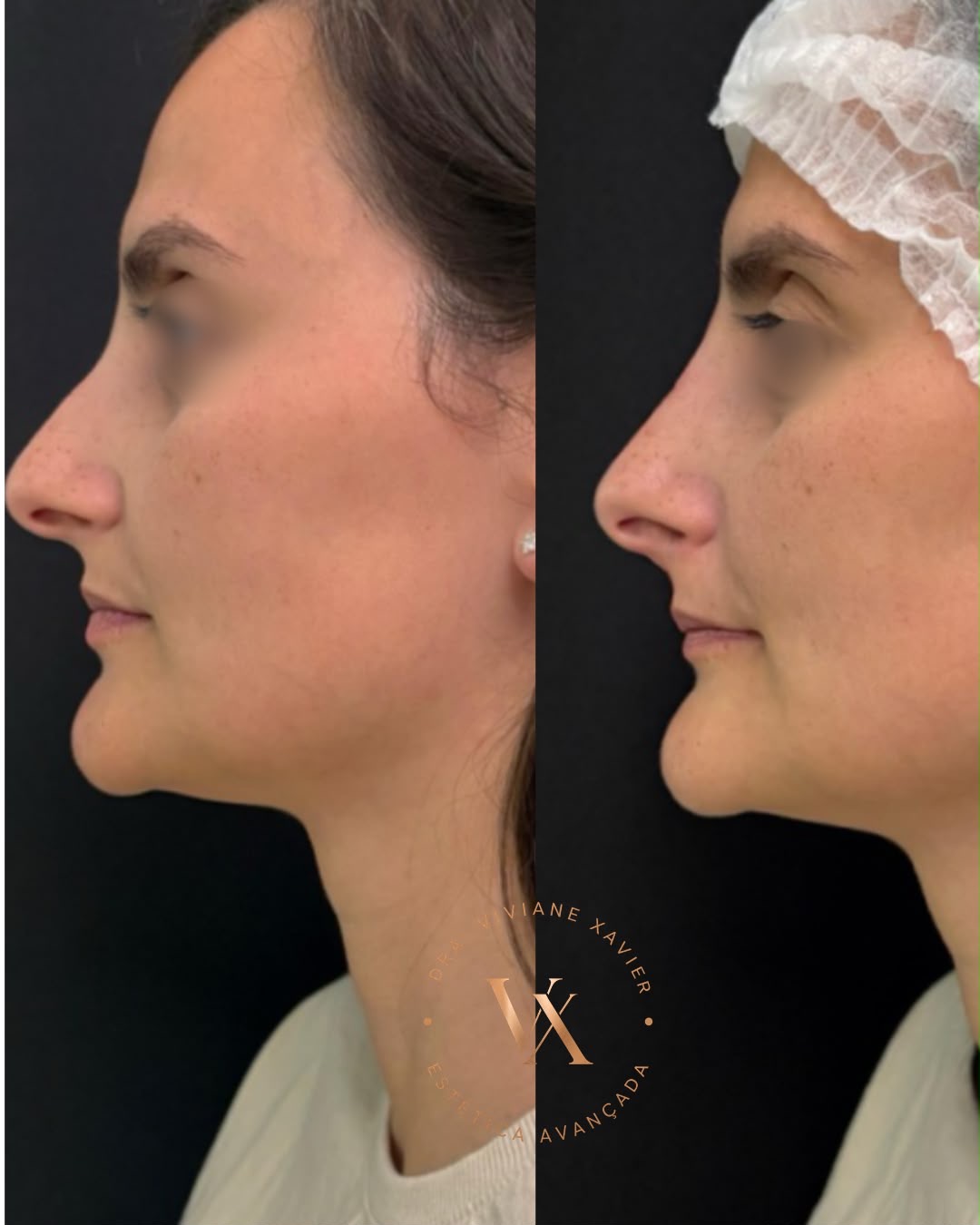 Antes e depois — perfil, resultado 1