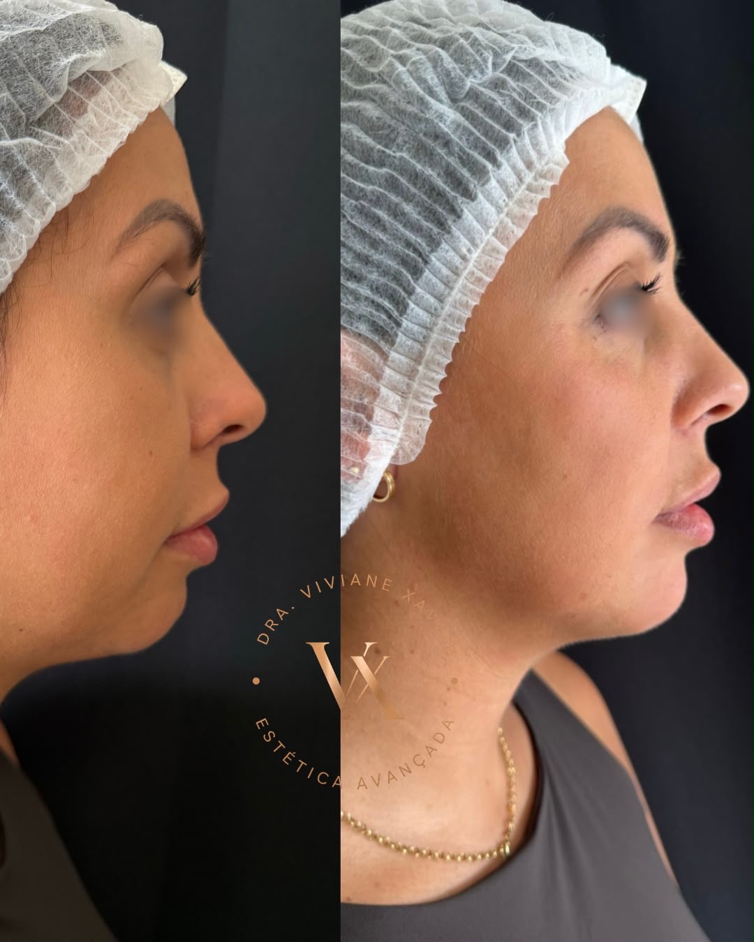 Antes e depois — perfil, resultado 2