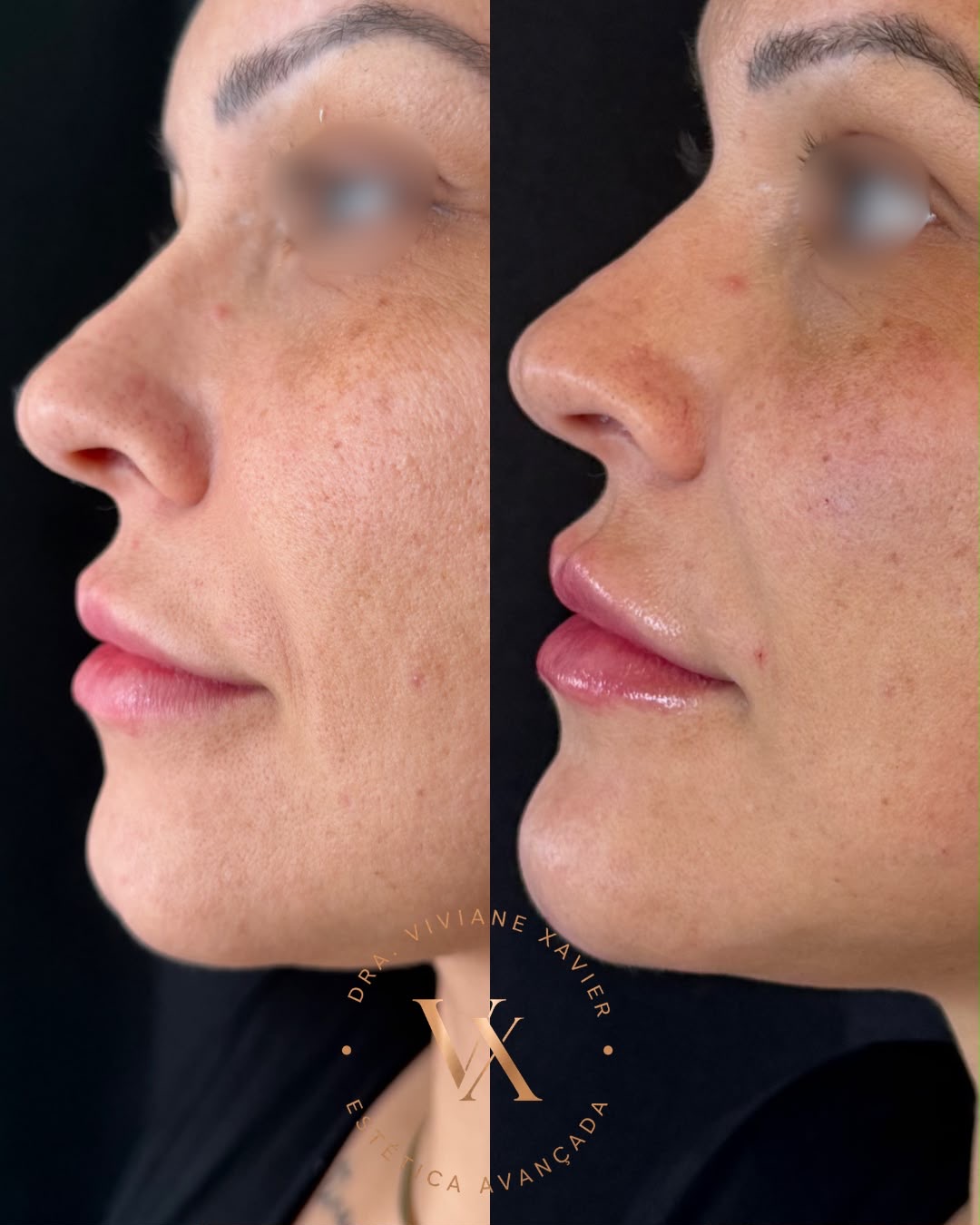 Antes e depois — perfil, resultado 3
