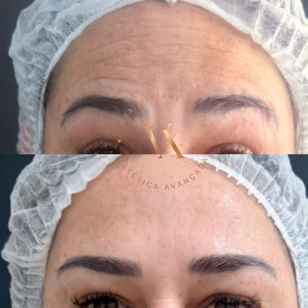 Antes e depois — testa, resultado 1