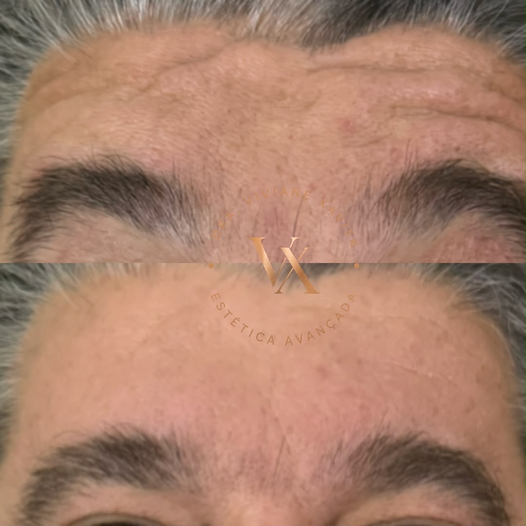 Antes e depois — testa, resultado 2