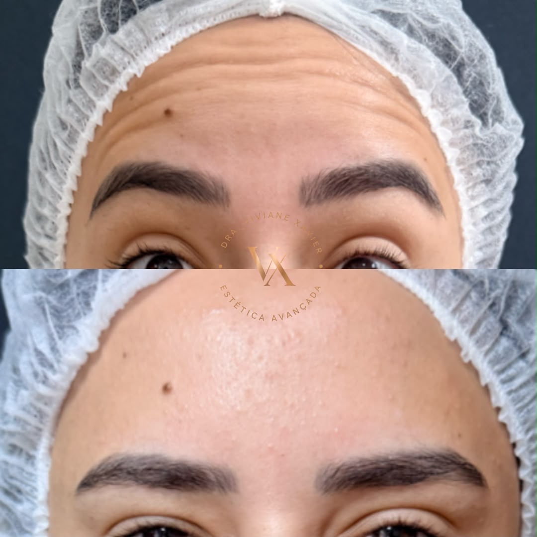 Antes e depois — testa, resultado 3